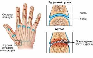 Артроз пальцев рук: как и чем лечить