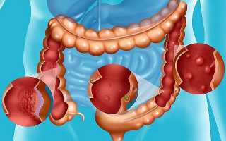 Ранние симптомы рака толстой кишки – диагностика и развитие болезни