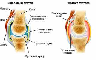 Лечение артрита коленного сустава: как вылечить болезнь