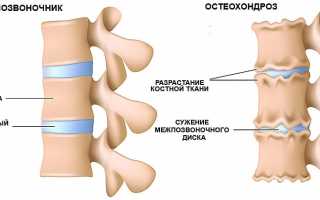 Лечение остеохондроза в домашних условиях