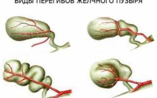 Что значит перегиб желчного пузыря – причины, симптомы и лечение