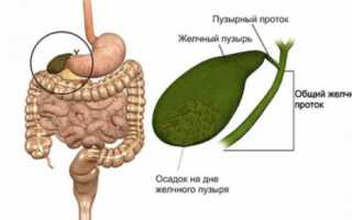 Что такое билиарный сладж желчного пузыря: диагностика и лечение