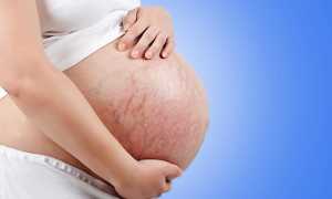 Вены на животе во время беременности