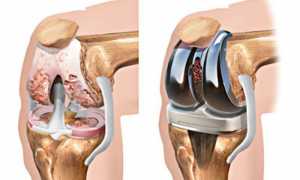 Реабилитация после замены коленного сустава
