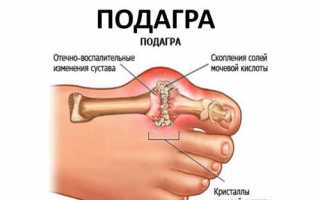 Диета при подагре: что можно и что нельзя есть