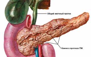 Некалькулезный холецистит: что это такое, симптомы, как лечить