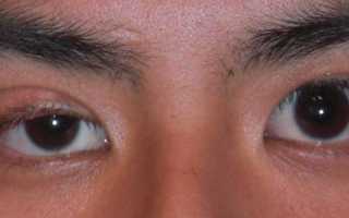 Почему дергается глаз, признаки и лечение блефароспазма