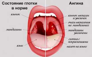 Причины и лечение отекших гланд