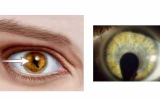 Особенности синдрома кошачьего глаза у человека