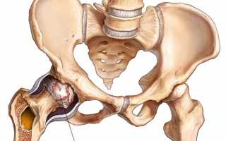 Коксартроз тазобедренного сустава: что такое и как лечить