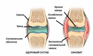 Синовит коленного сустава: что такое, признаки и причины