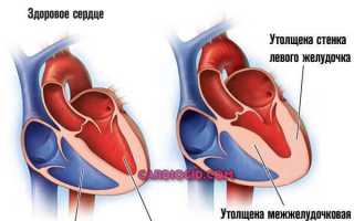 Гипертрофическая кардиомиопатия диагностика и лечение