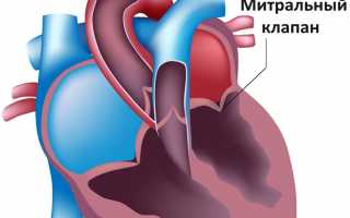 Что такое пролапс митрального клапана 1 степени