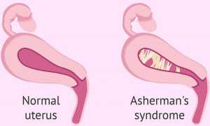 Возможна ли беременность при синдроме Ашермана