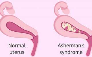 Возможна ли беременность при синдроме Ашермана
