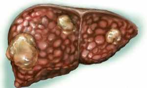 Липоматоз печени: симптомы, как избавиться от липом