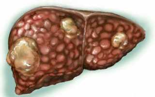 Липоматоз печени: симптомы, как избавиться от липом