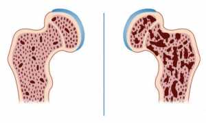 Остеопения и остеопороз: в чем разница этих заболеваний?