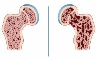 Остеопения и остеопороз: в чем разница этих заболеваний?