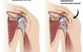 ЛФК при плечелопаточном периартрите
