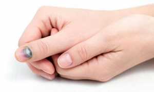 Цианоз ногтей пальцев