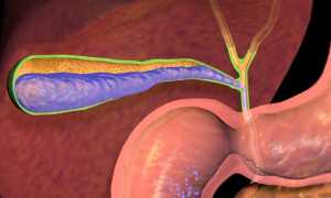 Воспаление желчных протоков: у взрослых и детей