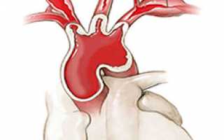 Синдром такаясу, артериит