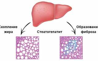 Стеатогепатит: что это за болезнь, как лечить, диета при лечении