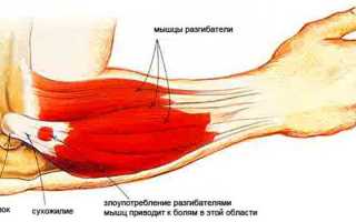 Эпикондилит локтевого сустава: что такое, признаки
