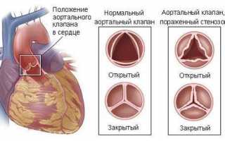 Кальциноз коронарных артерий что такое