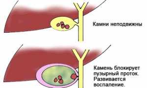 Острый холецистит: характер и локализация болей, классификация