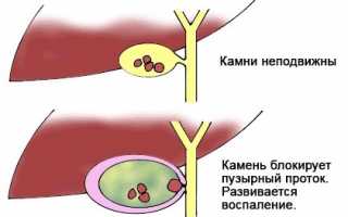 Острый холецистит: характер и локализация болей, классификация