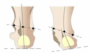 Вальгусная деформация стопы у детей: последствия и исправление