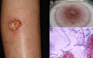 Глубокие микозы: симптомы и способы лечения