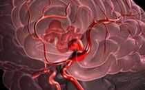 Признаки кровоизлияния в мозг после удара головой