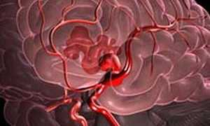 Признаки кровоизлияния в мозг после удара головой
