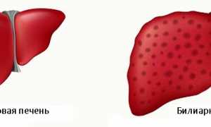 Билиарный цирроз: что это, виды, признаки