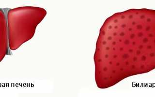 Билиарный цирроз: что это, виды, признаки