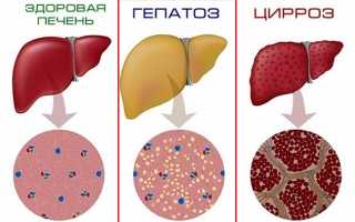 Жировой гепатоз печени: лечение народными средствами
