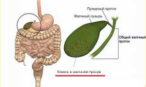 Взвесь в желчном пузыре: что это такое, как лечить