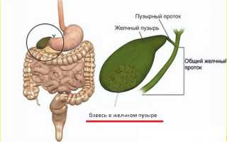 Взвесь в желчном пузыре: что это такое, как лечить