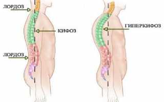 Кифоз: что это такое, признаки, фото