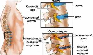 Остеохондроз поясничного отдела: как лечить