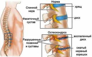 Остеохондроз поясничного отдела: как лечить