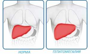 Гепатомегалия: что это такое и как лечить
