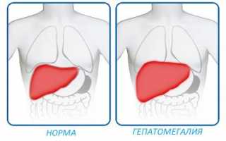 Гепатомегалия: что это такое и как лечить