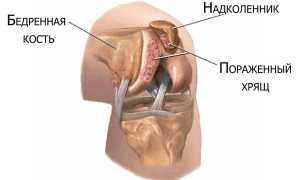 Хондромаляция надколенника: что такое, признаки, факторы риска