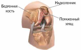 Хондромаляция надколенника: что такое, признаки, факторы риска