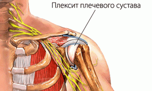 Плексит плечевого сустава: как вылечить