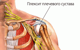 Плексит плечевого сустава: как вылечить